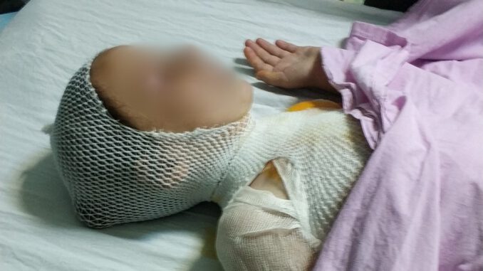 Kaynatılırken taşan süt hastanelik etti