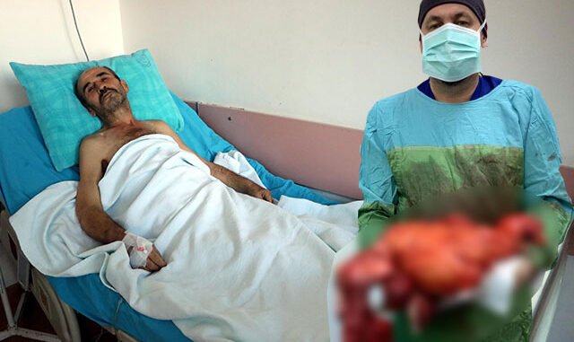 Karın Ağrısıyla Hastaneye Gitti, Karnından 11 Kiloluk Kitle Çıkarıldı
